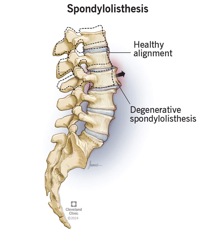 <p>Spondylolisthesis</p><ul><li><p>Anterior displacement of one vertebrae relative to the vertebra below it </p></li><li><p>contribute to <strong>nerve compression</strong></p></li></ul><p></p>