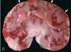 <p>Which chronicity is this renal infarct considered?</p>