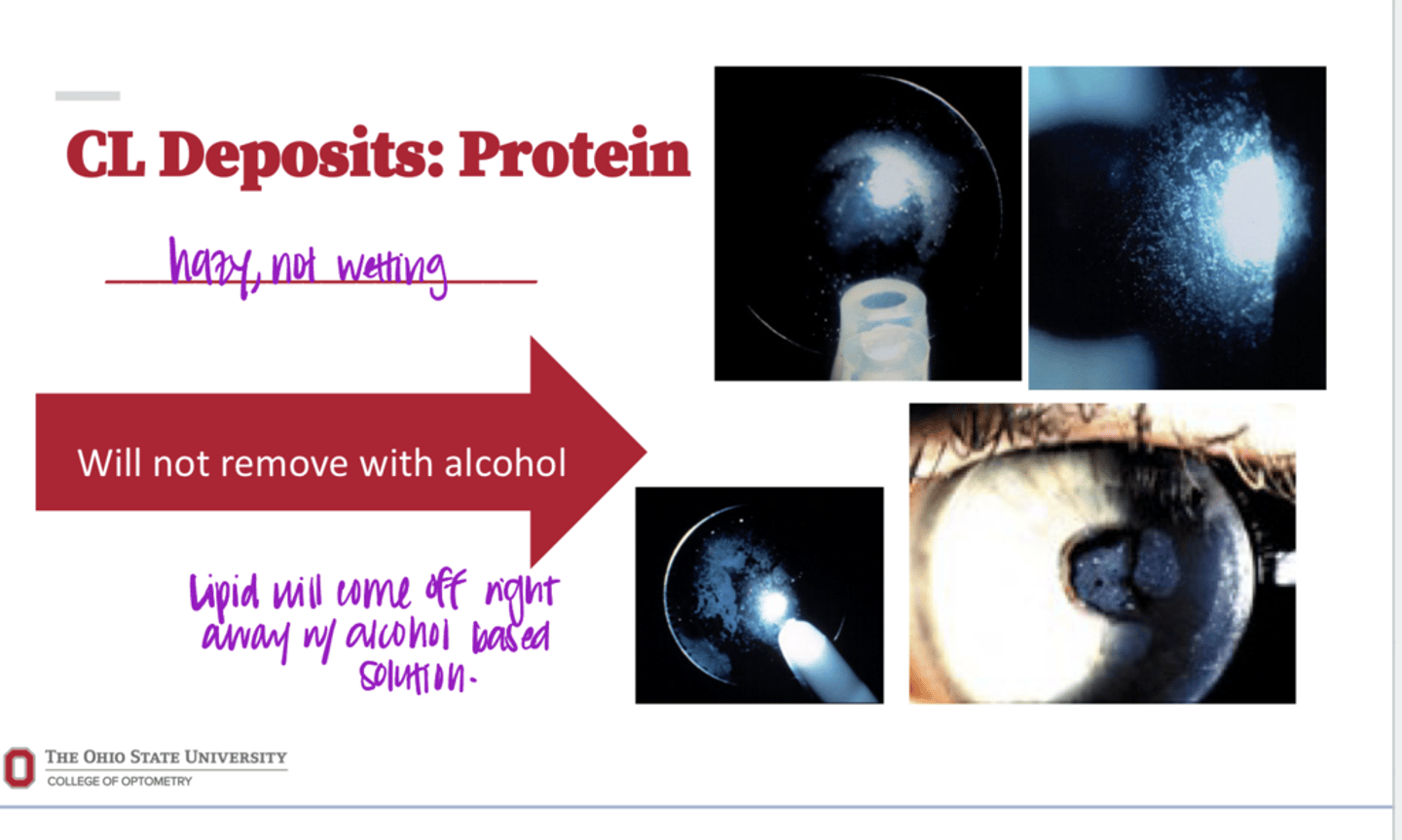 <p>Will protein deposits be removed from CLs with alcohol?</p>