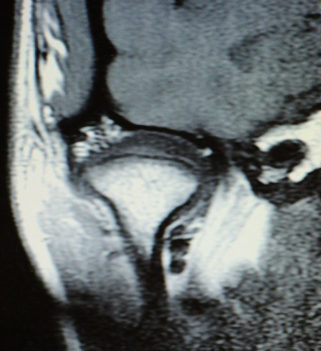 <p>Sagittal T1, PD, T2 + Fat/Sat for open and closed mouth.</p>