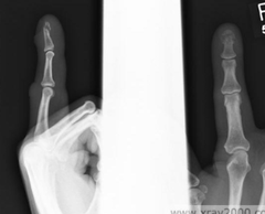 <p>comminuted fracture of the distal phalanx may be caused by a crushing blow to the distal finger or thumb</p>