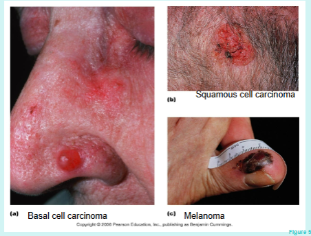 <ol><li><p>Basal Cell Carcinoma: involves proliferation of keratinocytes in stratum basale; least malignant and most common type of skin cancer (80%); grows slowly</p></li><li><p>Squamous Cell Carcinoma: involves cells in the stratum spinosum; second most common type of skin cancer; grows rapidly</p></li><li><p>Melanoma: proliferation of melanocytes; most aggressive type of skin cancer, highly metastatic and resistant to chemotherapy; least common</p></li></ol><p></p>