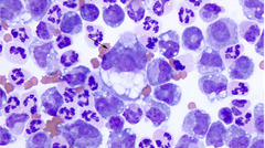 <p>What lesion is this?</p>