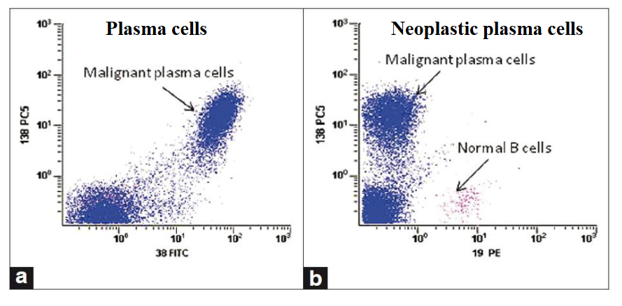 <p>- Antigens can be used to identify plasma cells and differentiate "normal" from "neoplastic"</p><p>.</p><p>PLASMA CELLS DEFINED BY CD38/CD138 DUAL EXPRESSION is diagram on LEFT</p><p>.</p><p>RIGHT IMAGE</p><p>NORMAL PLASMA CELLS: CD19 POSITIVE</p><p>NEOPLASTIC PLASMA CELLS: CD19 NEGATIVE</p>