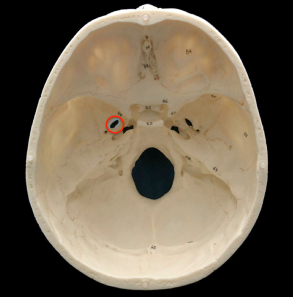<p>Skull Opening:</p><p>Foramen ovale</p><p>Muscle Group: </p><p>Mastication muscles</p><p>Key Muscles:</p><p>Masseter</p><p>Temporalis</p><p>Pterygoids</p><p>Main Function:</p><p>Chewing</p><p>Clinical Correlation:</p><p>Mandible fracture</p><p>Classic Symptoms:</p><p>Jaw deviation </p>