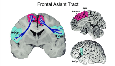 <p>frontal aslant tract damage </p>
