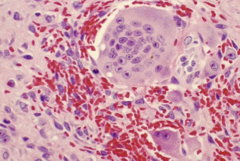 <p>the histopathology of central giant cell granuloma is identical to __</p>