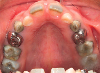 <p>caused by <em>biliary atresia</em></p><p>frequently produces <span style="color: red;">green discoloration of teeth</span></p>