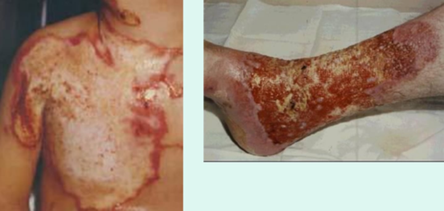 <p>involves the epidermis, dermis, and hypodermis</p><p>colorless (waxy white, or leathery gray)</p><p>typically painless</p>