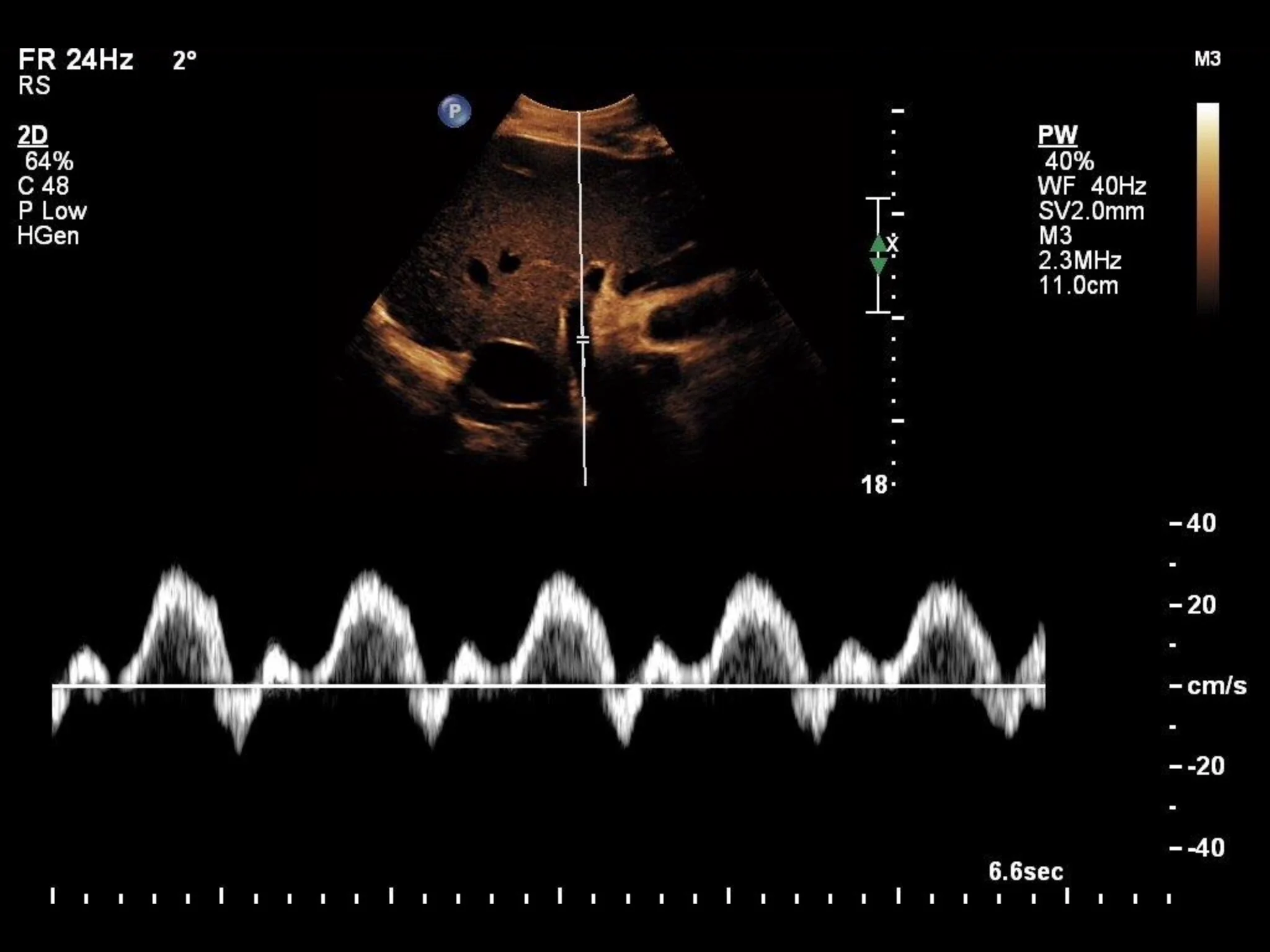 <p>Portal vein. What do you suspect?</p>