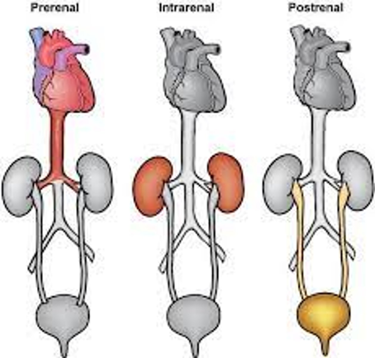 <p>C) Lack of perfusion (blood flow), such as from a myocardial infarction (MI)</p>