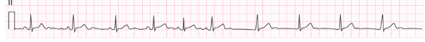 <p>An irregularly irregular rhythm characterized by sharp P waves and irregular r-r &amp; p-p intervals.</p>