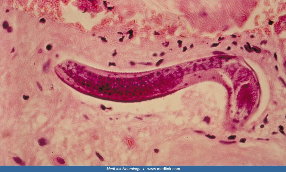 <p>While volunteering in a rural clinic, 29-year-old Dr. Emily noticed several patients presenting with symptoms of myositis, fever, and subconjunctival hemorrhages. </p><p>She knew that these were signs of a parasitic infection, often associated with the ingestion of larvae from infected meat, and she recalled the spiraled appearance of the larvae under the microscope.</p>