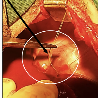 <p>What type of tourniquet can be used on the renal vessels when doing a partial nephrectomy? Part of the kidney is cut off, and the remainder is sutured with the outer serosa layer covering the medulla surface.</p>