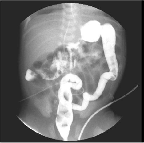 <p>A condition in which the ileum becomes blocked due to thick, sticky meconium in newborns, often associated with cystic fibrosis. It can lead to bowel obstruction and requires surgical intervention.</p>