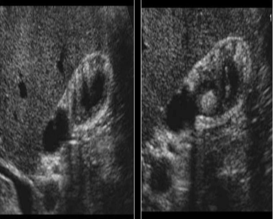 <p>Which of the following is a true statement regarding the displayed image? </p><p>a. the GB is contracted with thickened wall and pus formation caused by infection</p><p>b. the GB is contracted and contains multiple shadowing stones within the lumen</p><p>c. the GB is contracted with thickened walls and polyp formation caused by adenomyomatosis</p><p>d. the GB is contracted with thickened walls and polyp formation caused by adenocarcinoma</p>