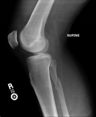 <p>maisonneuve fracture (order tib/fib series and ankle)</p><p>Maisonneuve Fracture: spiral fracture of the proximal third of the fibula associated with an avulsion fracture of the medial malleolus secondary to a disruption/rupture of the deltoid ligament</p>