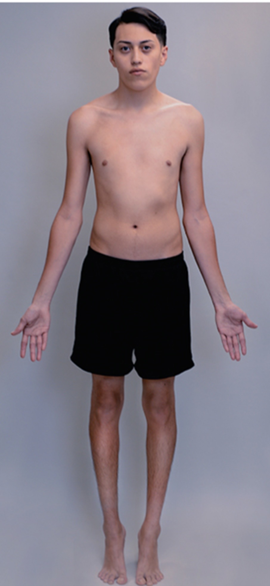 <p>The position of reference in which the patient stands facing forward, arms at the side, with the palms of the hands forward.</p>