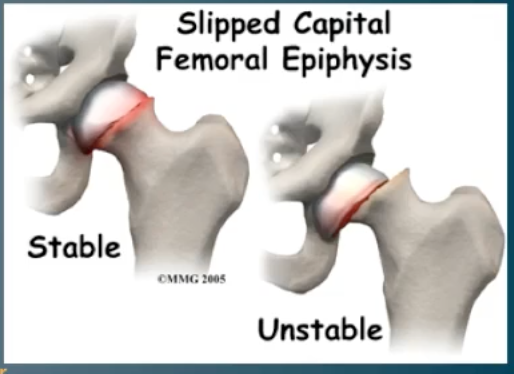 <p>Gradual displacement / slippage of the femoral head at the growth plate, causing hip pain and limp in adolescents</p>
