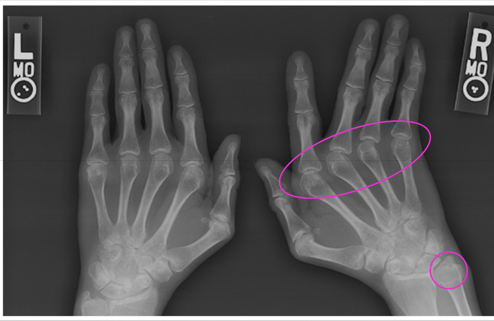 <p>What findings of SLE does this x-ray show</p>