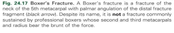 <p>Boxer’s fracture</p>