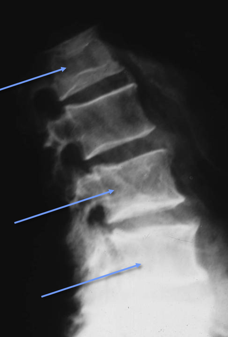<p>What tumour like disorder is this, what can you see?</p>