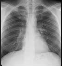 <ul><li><p>Scapula is seen in the periphery of the thorax</p></li><li><p>Clavicles project over lung fields</p></li><li><p>Posterior ribs are distinct</p></li><li><p>Position of markers</p></li></ul><p></p>