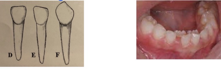 <p>Due to lingual eruption of permanent </p><p>Careful luxation movements if atypical root resorption as the root will be long but extremely thin</p>