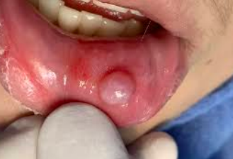 <p><span style="color: red;">fluid-filled sac</span> that can develop in various tissues, often benign</p>