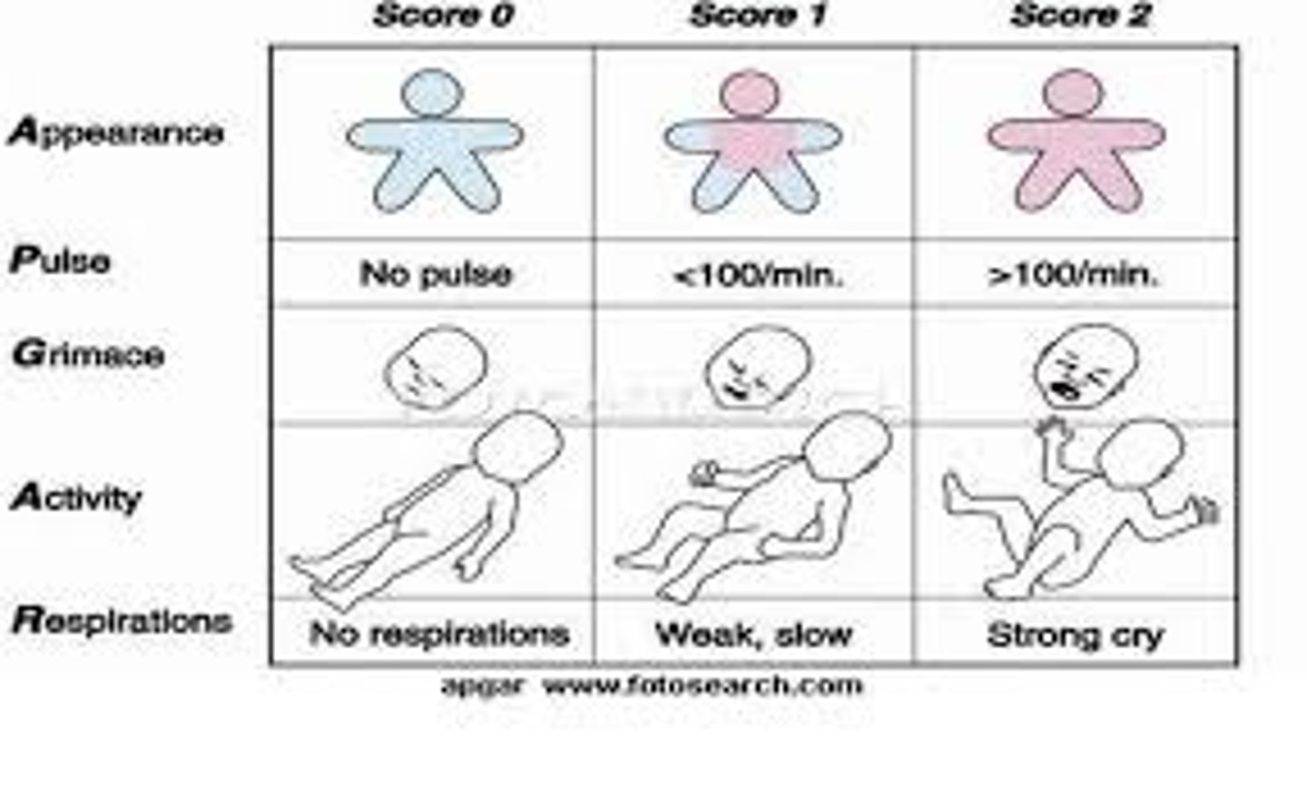 <p>- <strong>standard measurement</strong> of a newborn's condition. </p><p>- It assesses <strong>appearance</strong>, <strong>pulse</strong>, <strong>grimace</strong>, <strong>activity</strong>, and <strong>respiration</strong>.</p><p>- Newborn is rated for a maximum of 10.</p><p>- <strong>Below 7</strong> (needs help establishing breathing)</p><p>-<strong> Below 4</strong> (needs immediate lifesaving treatment)</p>
