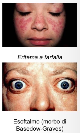 <p><span>Una facies normale si definisce </span><strong><span>composita</span></strong><span>. Si ricercano alterazioni cutanee (es. eritema a farfalla nel LES), del colorito (pallore, cianosi, ittero) e della simmetria (dismorfismi, processi espansivi, alterazioni muscolari).</span></p>