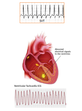 <ul><li><p>resting HR more than 100bpm (less distance between waves, don’t get proper relaxation)</p></li></ul><p></p>