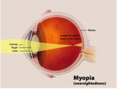 <p>nearsightedness - unable to see things that are far away</p>