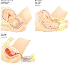 <p>•Stage One (Dilation)</p><p>•Stage Two (Expulsion)</p><p>•Stage Three (Placental Stage)</p>