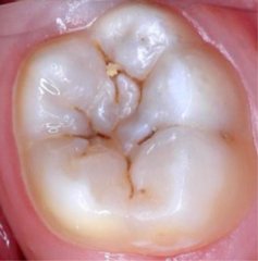 <p>What ICDAS score would be given to this tooth?</p>