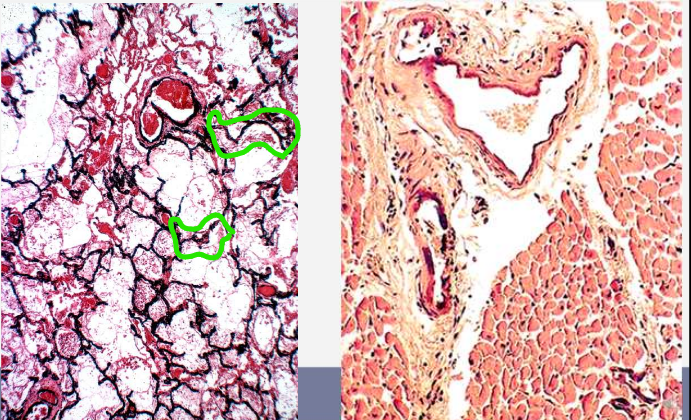 <ul><li><p>audinys sveikas, bet Ca konc. kraujyje padidėjusi (hiperkalcinemija)</p></li><li><p>atsiranda dėl navikų metastazės kauluose, padidėjusi Ca absorbcija, Ca išsiskyrimas iš kaulų, sumažėjęs Ca išsiskyrimas pro inkstus, vit D perteklius</p></li><li><p>dažniausiai inkstuose, plaučiuose</p></li></ul><p></p>