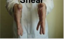 <p>Non-physiologic. 2 transverse axises. Sphenoid and occiput will rotate in the same direction. Fingers will point down while hands rotate anteriorly. </p><p></p><p>Extra Info for Comp:</p><p>Vertical strain patterns do not change the AP diameter and result from a shearing force, either superiorly or inferiorly, acting on the SBS. Such a force can be generated by an uppercut force to the chin, for example, or a downward impact on the top of the head, whether from the front or back.</p><p>Named based on the position of the base of the sphenoid at the SBS relative to the occipital base. When the base of the sphenoid moves superiorly, it’s a superior strain.</p><p>Both sphenoid and occiput bones rotate anteriorly in a superior strain.</p><p>So, in a superior vertical strain, the sphenoid rotates forward or anteriorly, which moves the base of the sphenoid superiorly. Simultaneously, the occipital also rotates forward, shifting the base of the occipital inferiorly at the SBS.</p><p></p>
