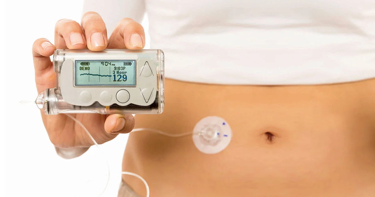 <p>A device that delivers insulin through a sensor inserted subcutaneously, using wireless technology.</p>