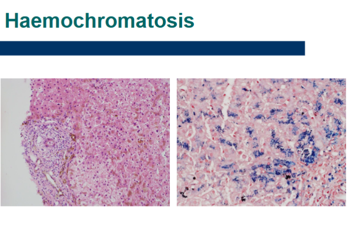 <p>Iron → irritation/injury → fibrosis → nodule formation → micronodular cirrhosis</p>