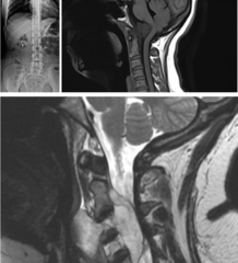 <p>What is this?</p><p>- 30-70 yo</p><p>- Pain (From mass effect)</p><p>- Ends of axial skeleton (Sacrococygeal Jxn, Spheno-occipital Jxn, VB)</p>