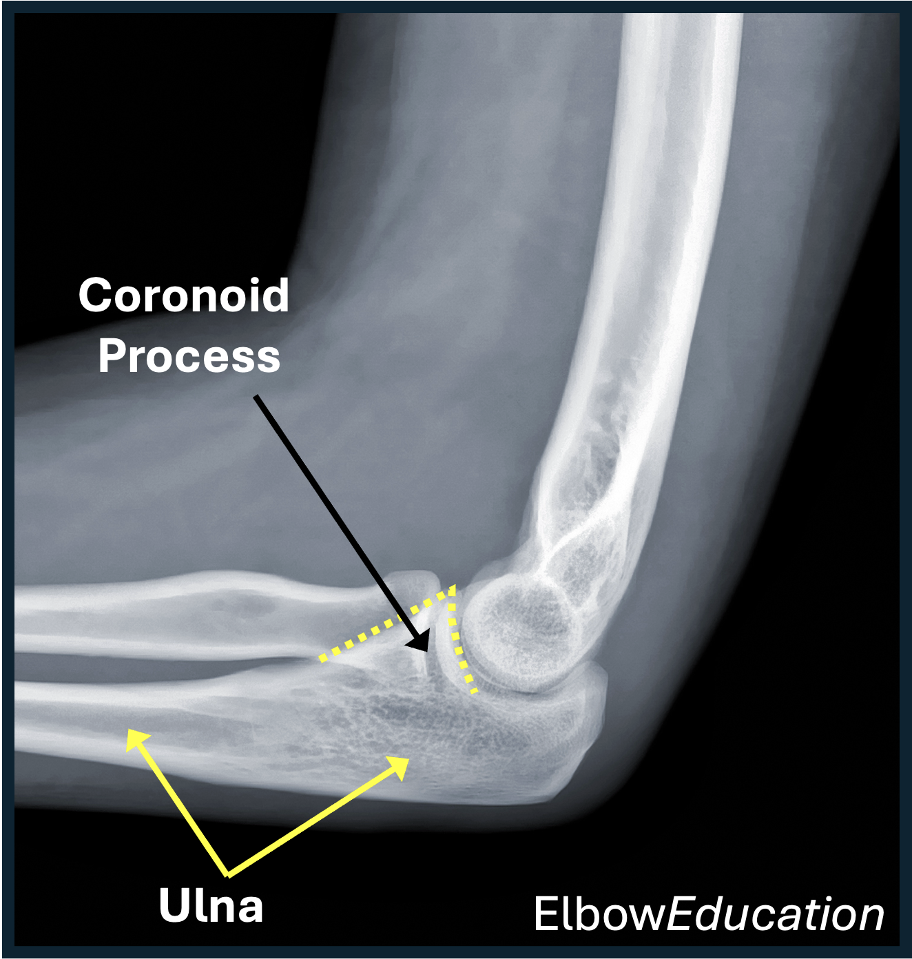 <p><strong>Proximal Ulna</strong>: Coronoid process </p>