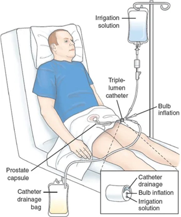 <ul><li><p>Bladder CA: focus on urine characteristics mostly; UTIs, <strong>painless hematuria</strong>, and changes to voiding patterns are commonly seen </p><ul><li><p>Back and pelvic pain typically is associated with metastasis </p></li></ul></li><li><p>Prostate CA: may include signs of obstruction, blood in urine or semen, and painful ejaculation </p><ul><li><p>Sexual dysfunction is a common <strong>early sign </strong></p></li></ul></li></ul><p></p>