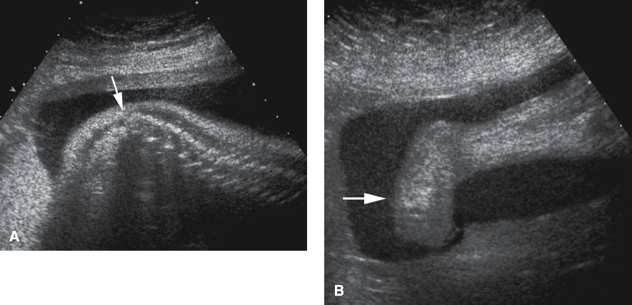<p>Absent sacrum (sacral agenesis) and possibly part of the lumbar vertebra</p><p>Possible abnormalities in the lower extremities like clubfeet</p>