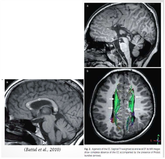 <p><span>Lack or partial lack of the CC. Fibers migrate ipsilaterally &amp; course along the lateral<br>ventricles forming Probst bundles. Not connected. Can function without the corpus callosum. Few observable symptoms. </span></p>