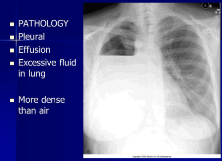 <p>blunted angles → pleural effusion</p>