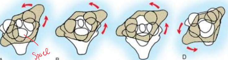 <p>Type 1 (Stable)</p><ul><li><p>Simple rotary subluxation without anterior shift</p></li><li><p>Odontoid acts as a pivot</p></li></ul><p></p><p>Type 2 (Stable)</p><ul><li><p>Rotary displacement with anterior displacement of 3-5mm</p></li><li><p>Lateral articular process act as pivot</p></li></ul><p></p><p>Type 3(Not stable)</p><ul><li><p>Rotary displacement with anterior displacement of >5mm</p></li></ul><p></p><p>Type 4 (Not stable)</p><ul><li><p>Rotary displacement with posterior displacement</p></li></ul><p></p>