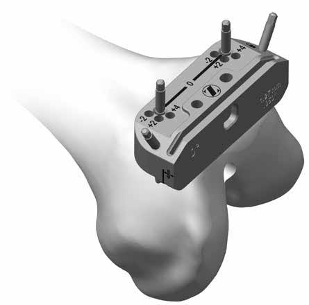 <p>Guides the distal femur resection.</p>