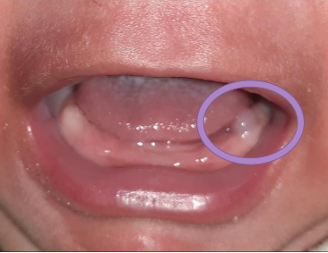 <p>Spot the cyst and provide diagnosis</p>