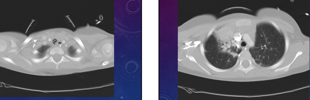 <p>What does chest scan show</p>