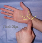 <p>Purpose</p><ul><li><p>Assess for carpal tunnel syndrome</p></li></ul><p>Position</p><ul><li><p>Sitting with forearms supinated </p></li></ul><p>Technique</p><ul><li><p>Examiner supports patients supinated wrist and hand in one hand while using the index or middle fingertip to percuss over the transverse ligament </p></li></ul><p>Interpretation</p><ul><li><p>(-): patient has no CTS symptoms while percussing </p></li><li><p>(+): patient experiences reproducible CTS symptoms including numbness, tingling, and/or burning along the distribution of the median nerve suggestive of CTS</p></li></ul><p></p><p></p>